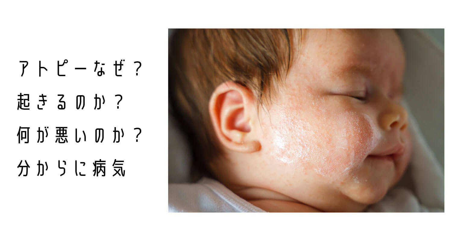 あなたが現在見ているのは AAA美容法アップデート❗皮膚炎・アトピー