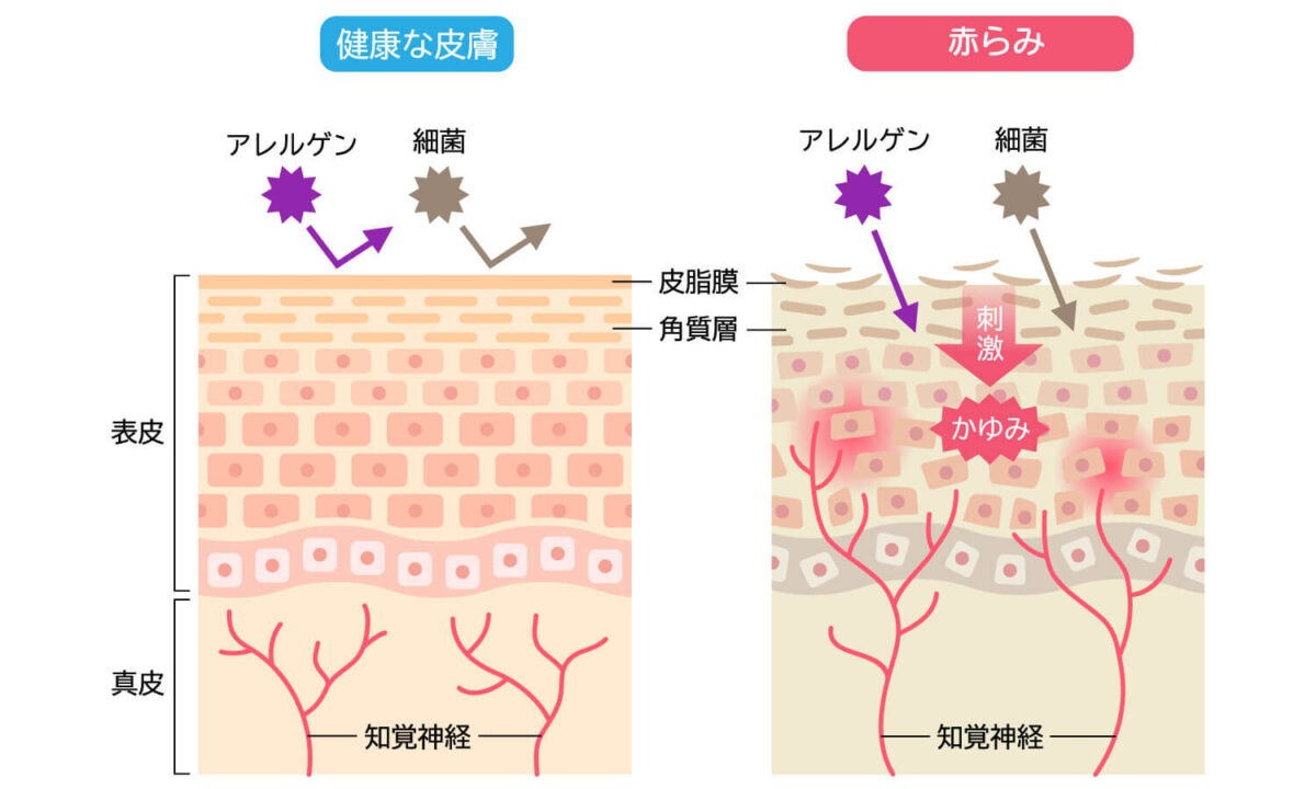 赤らみ