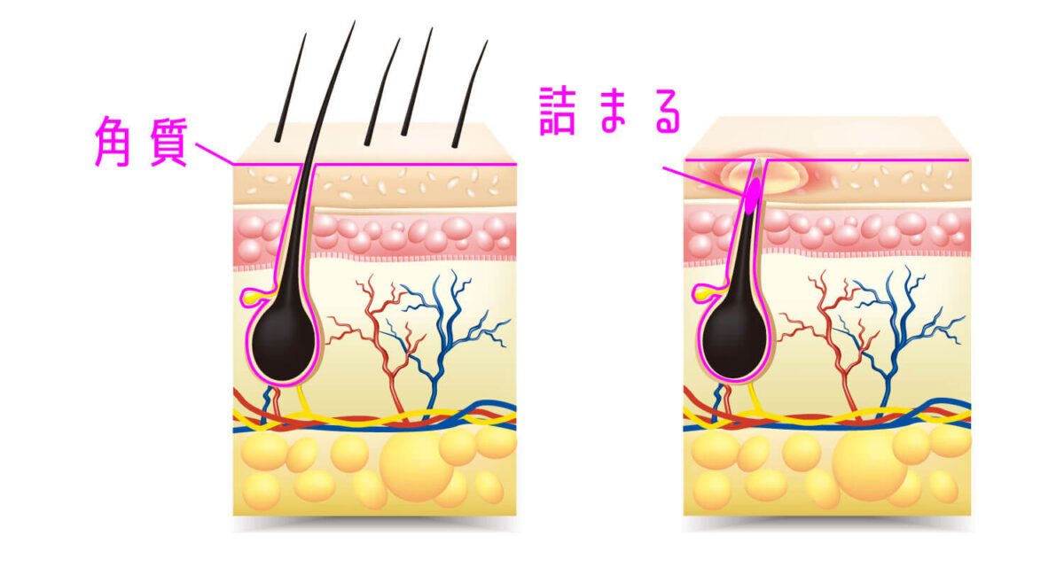 ニキビ画像