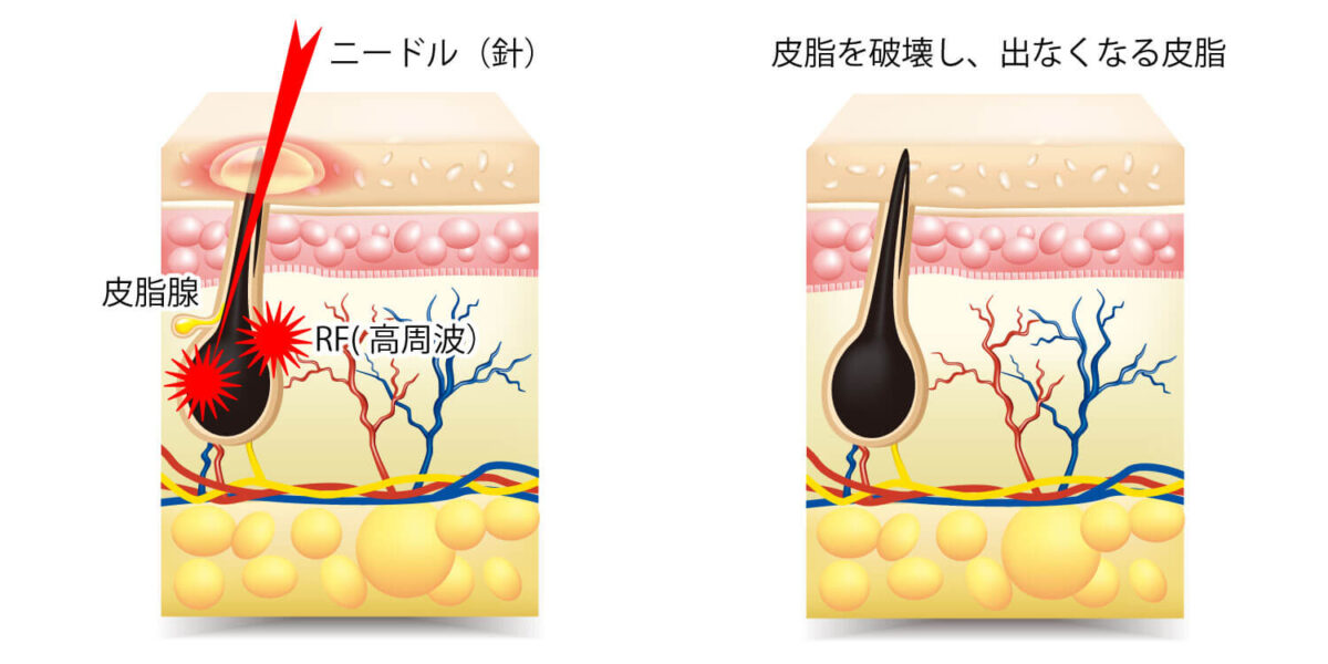 アグネス治療