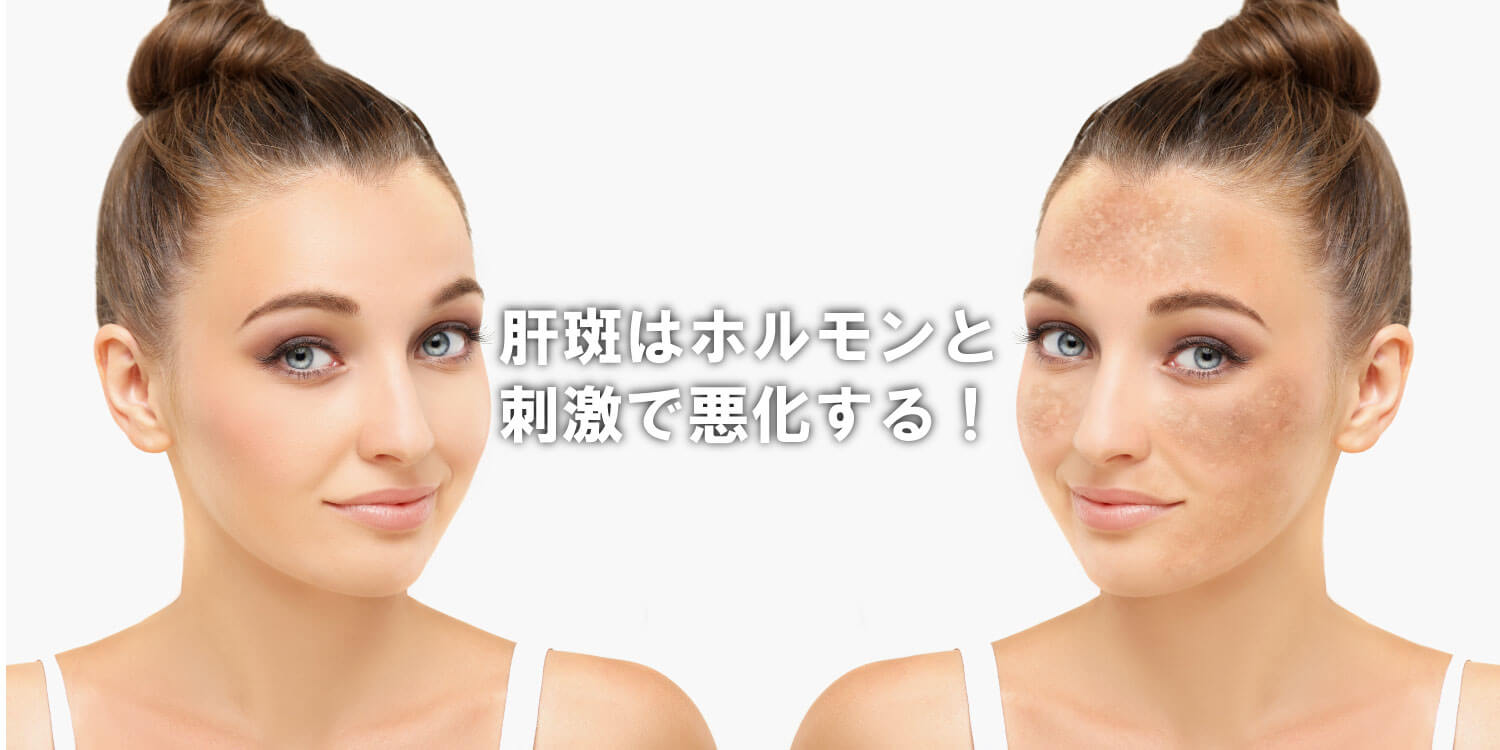 あなたが現在見ているのは 肝斑の原因と考え方🤔