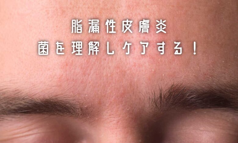脂漏性皮膚炎